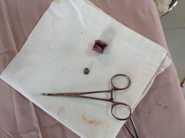 Střepiny granátu, které jsme vyndali z pacientovy pánve…