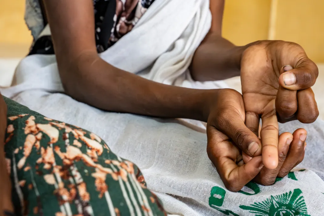 Kasanesh Ambaye (12), showing where the snake bit her