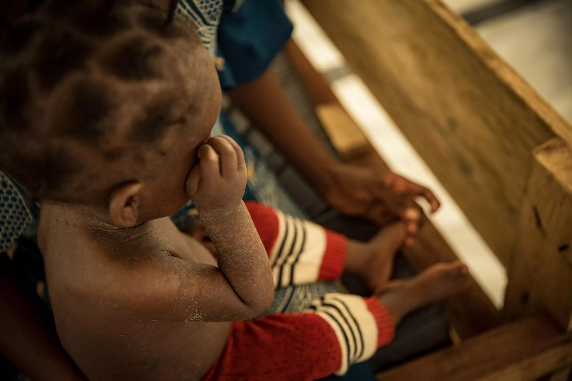 Measles in Kalole